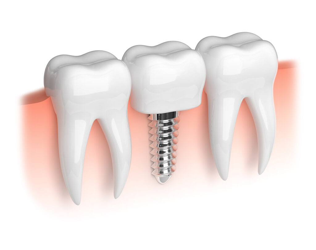 dentures, implants, restorative dental care Surprise, bridge