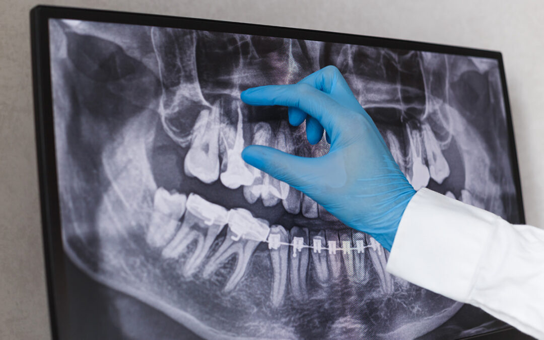 Understanding Root Canal Treatment: What to Expect and How to Prepare