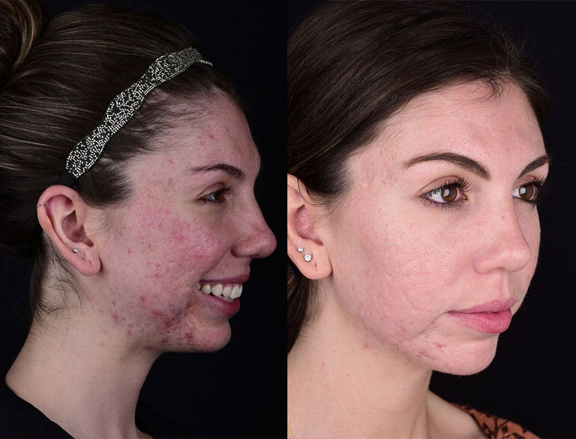 PRF Facial Rejuvenation,Dentist